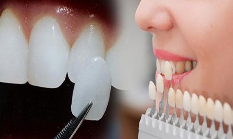 Dán răng sứ Veneer - Top 9 sự thật mà bạn nên biết
